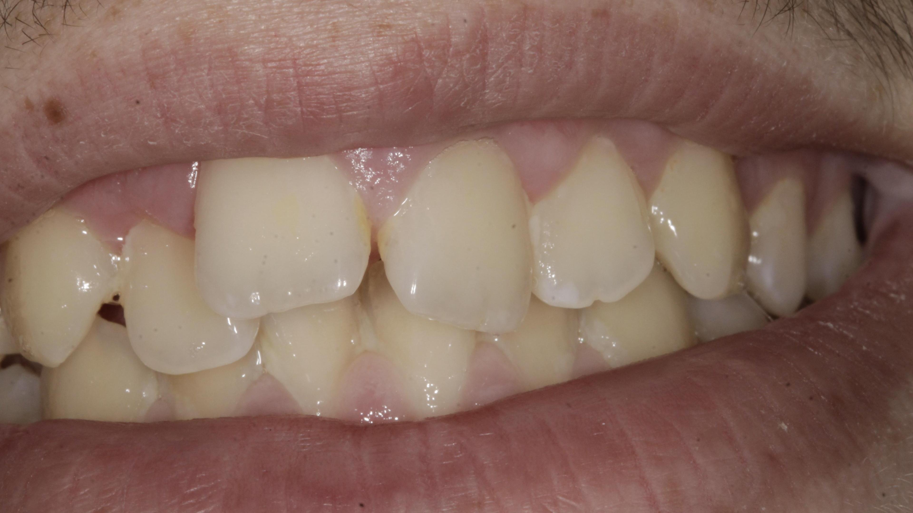 Orthodontc treatment in children Before treatment - Upper dental arch constriction