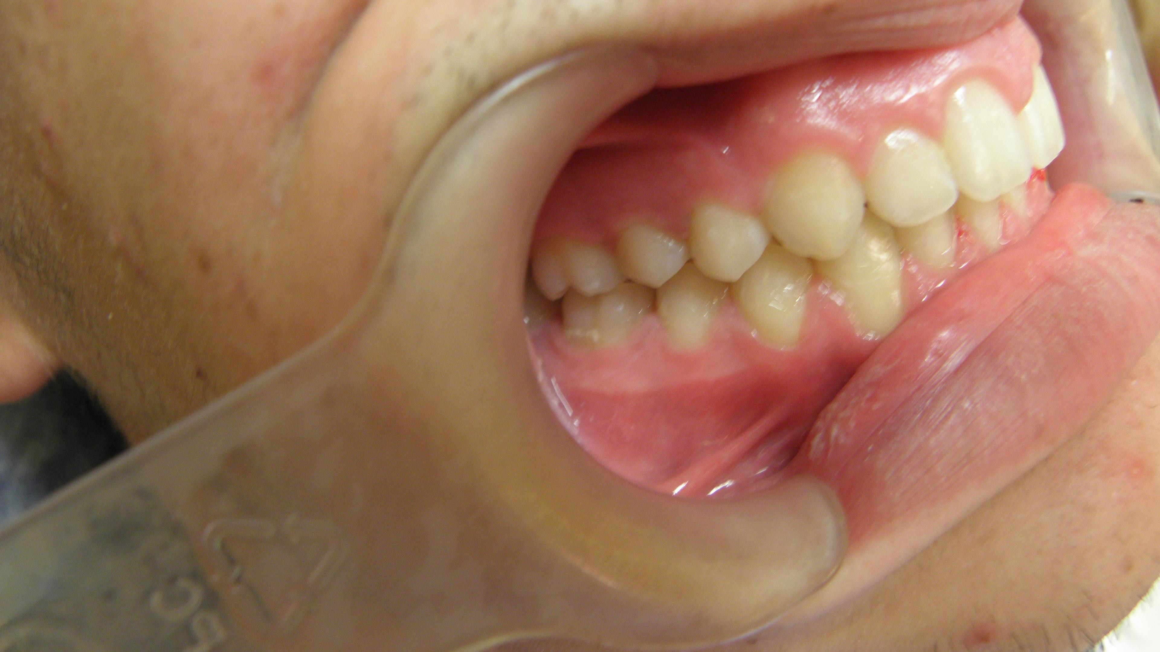 Orthodontc treatment in children After treatment - Upper dental arch constriction