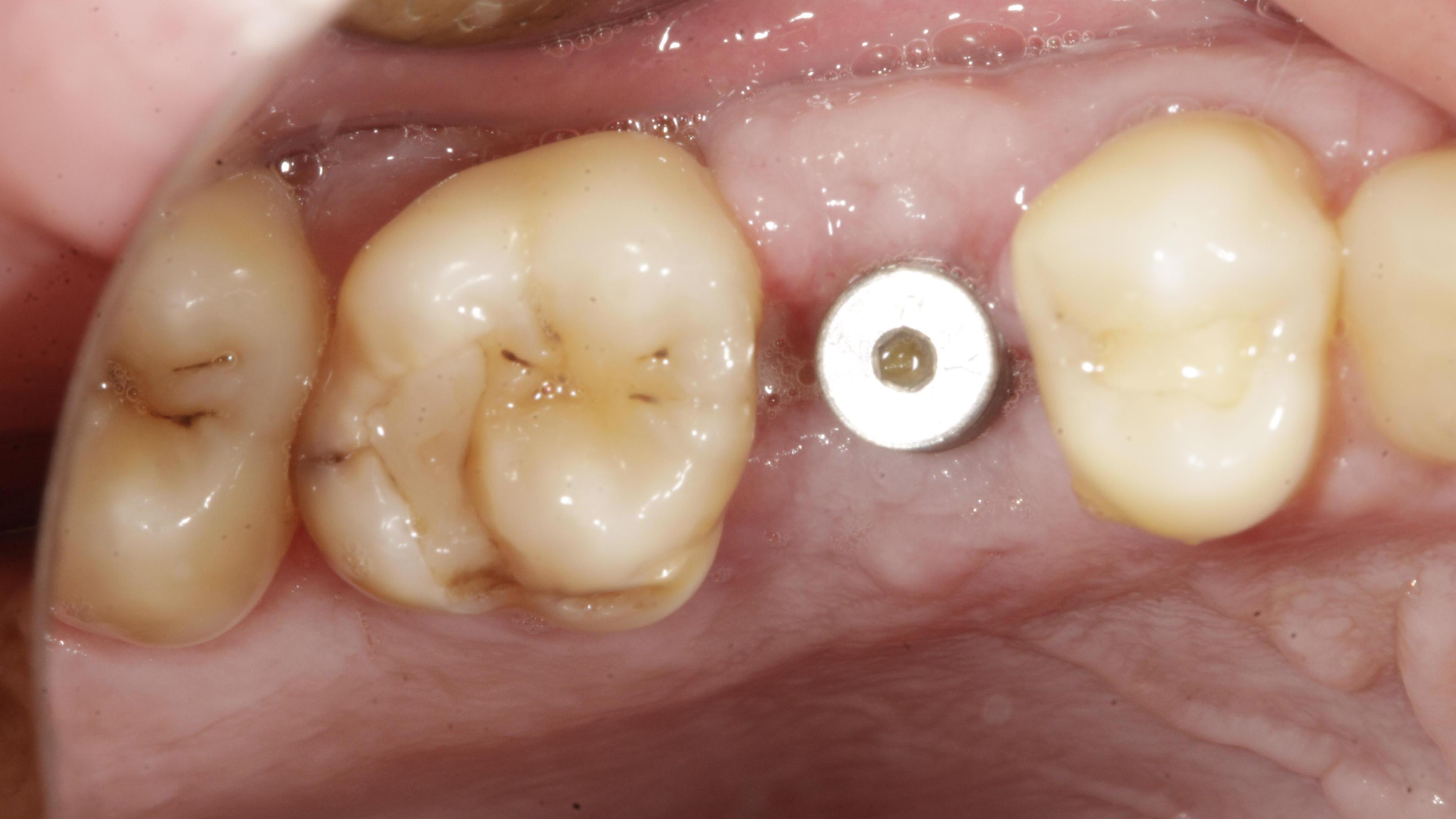 Single tooth loss After treatment - Single implant