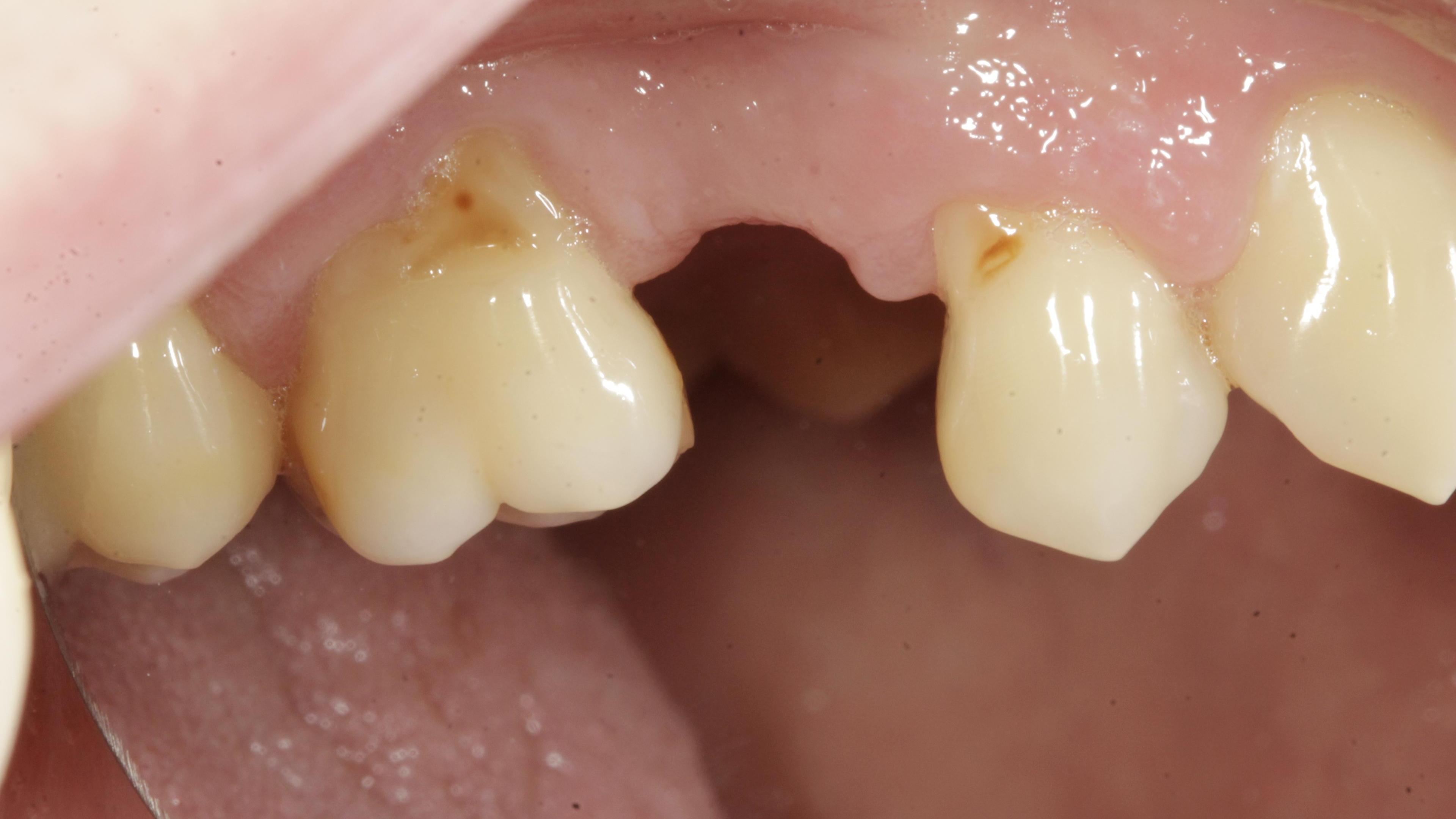 Single tooth loss Before treatment - Single implant