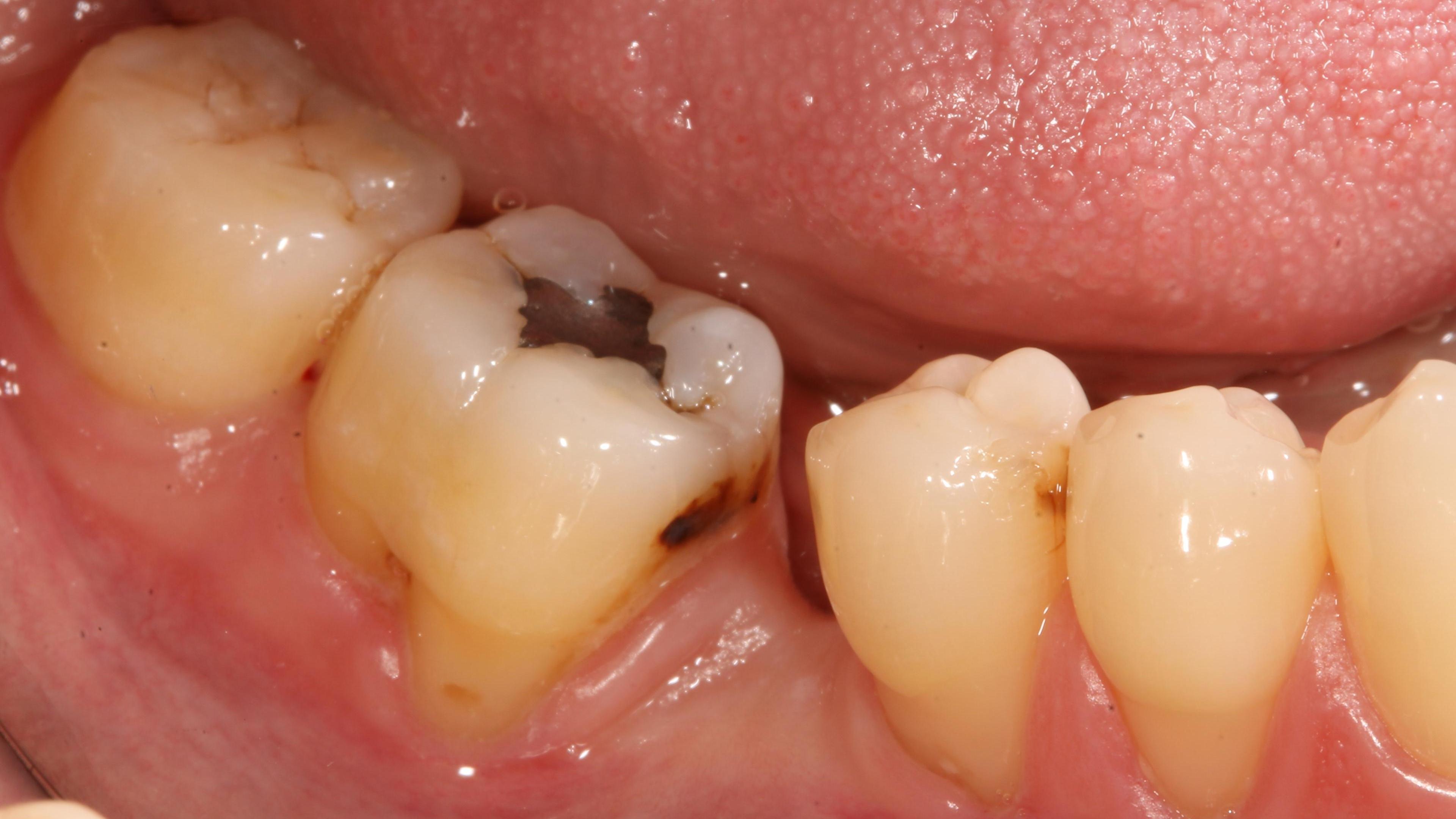 Periodontal plastic surgery Before treatment - Root recessions
