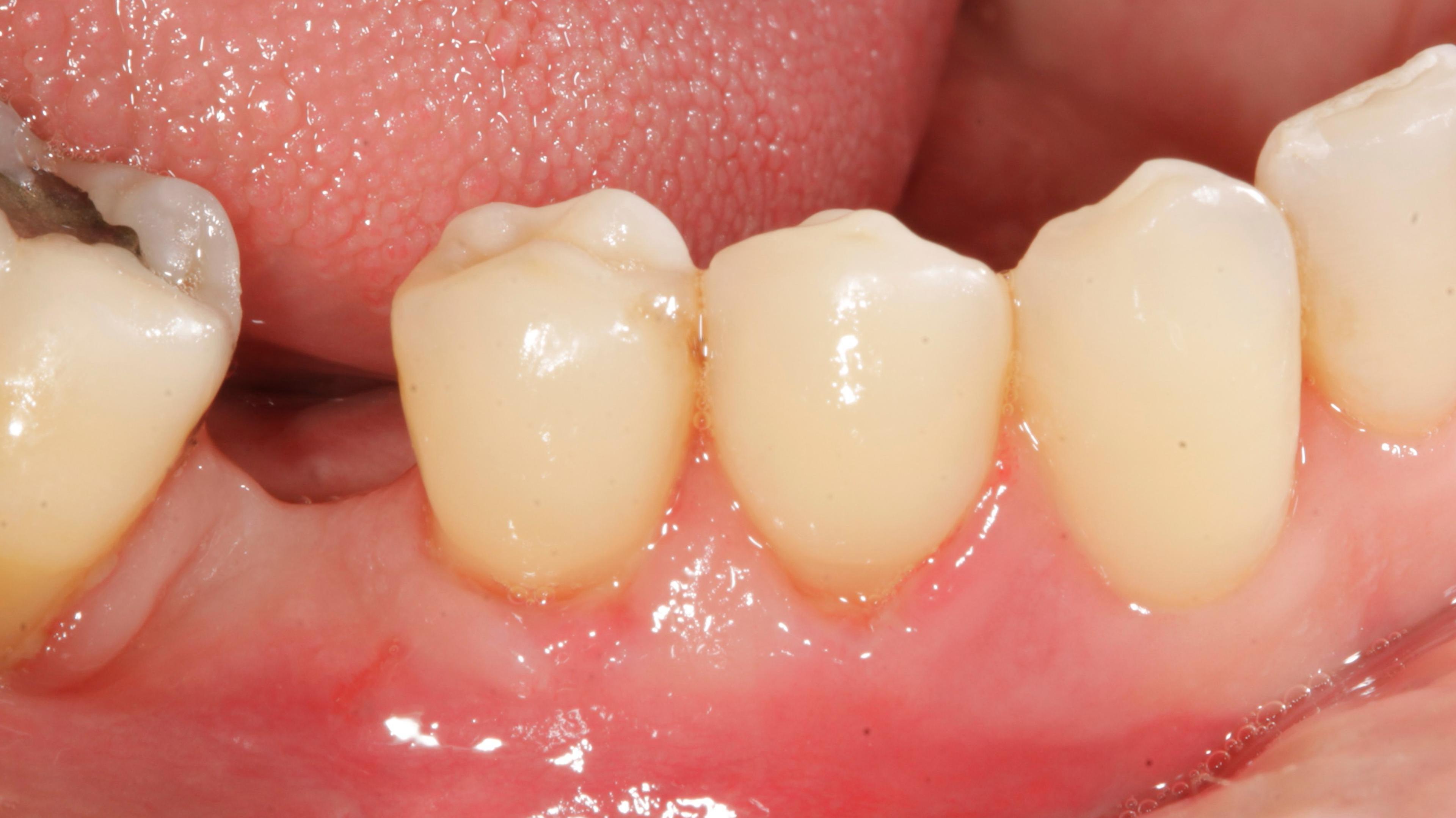 Periodontal plastic surgery After treatment - Root recessions