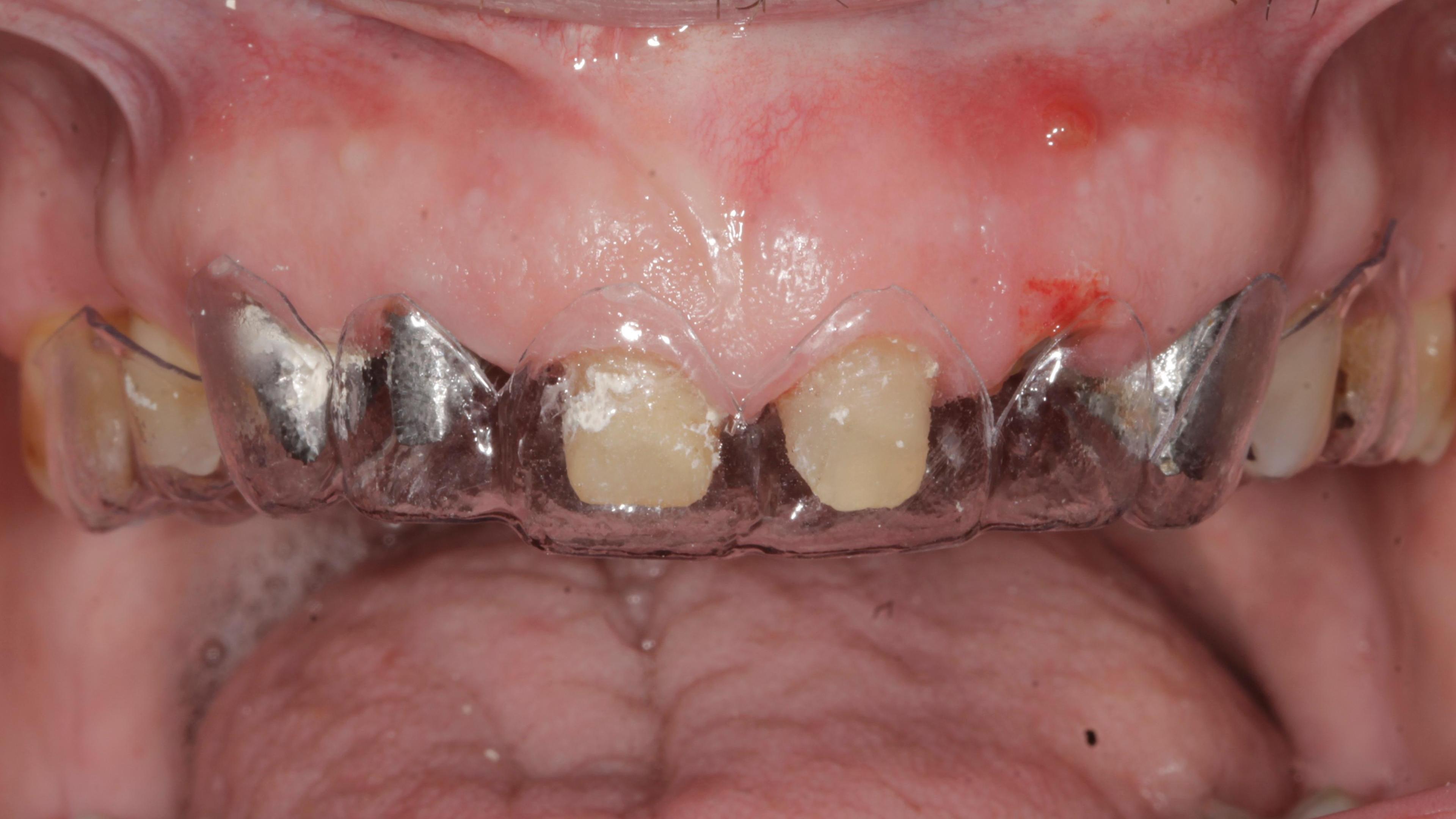 Crown lengthening Before treatment - Crown lengthening in the aesthetic zone