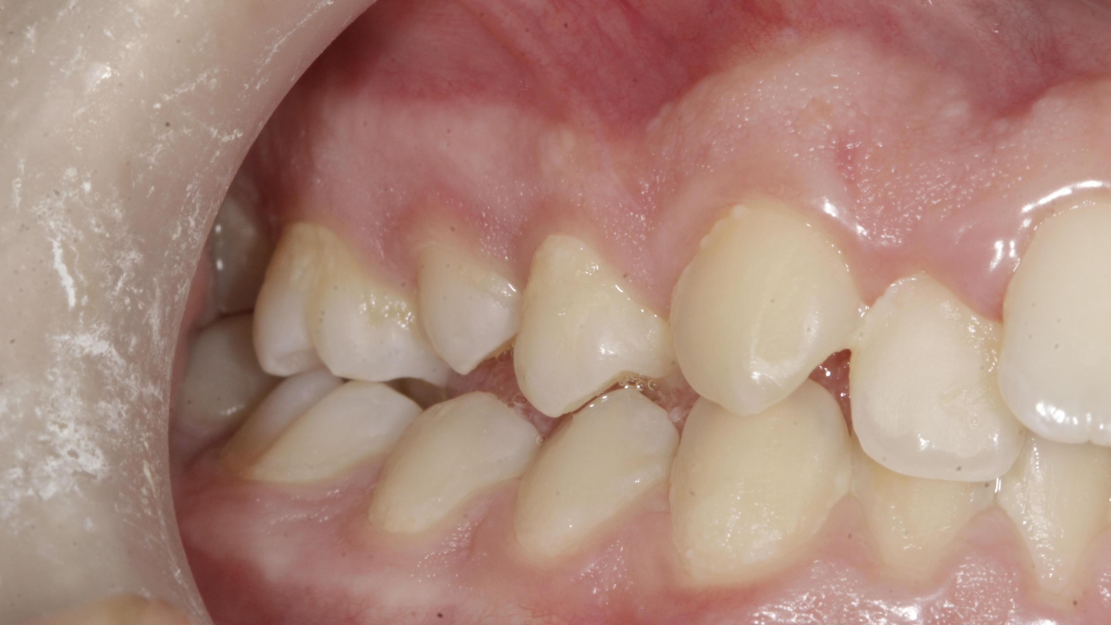 Ορθοδοντική παίδων Πριν την θεραπεία - Συνωστισμός άνω οδοντικού τόξου