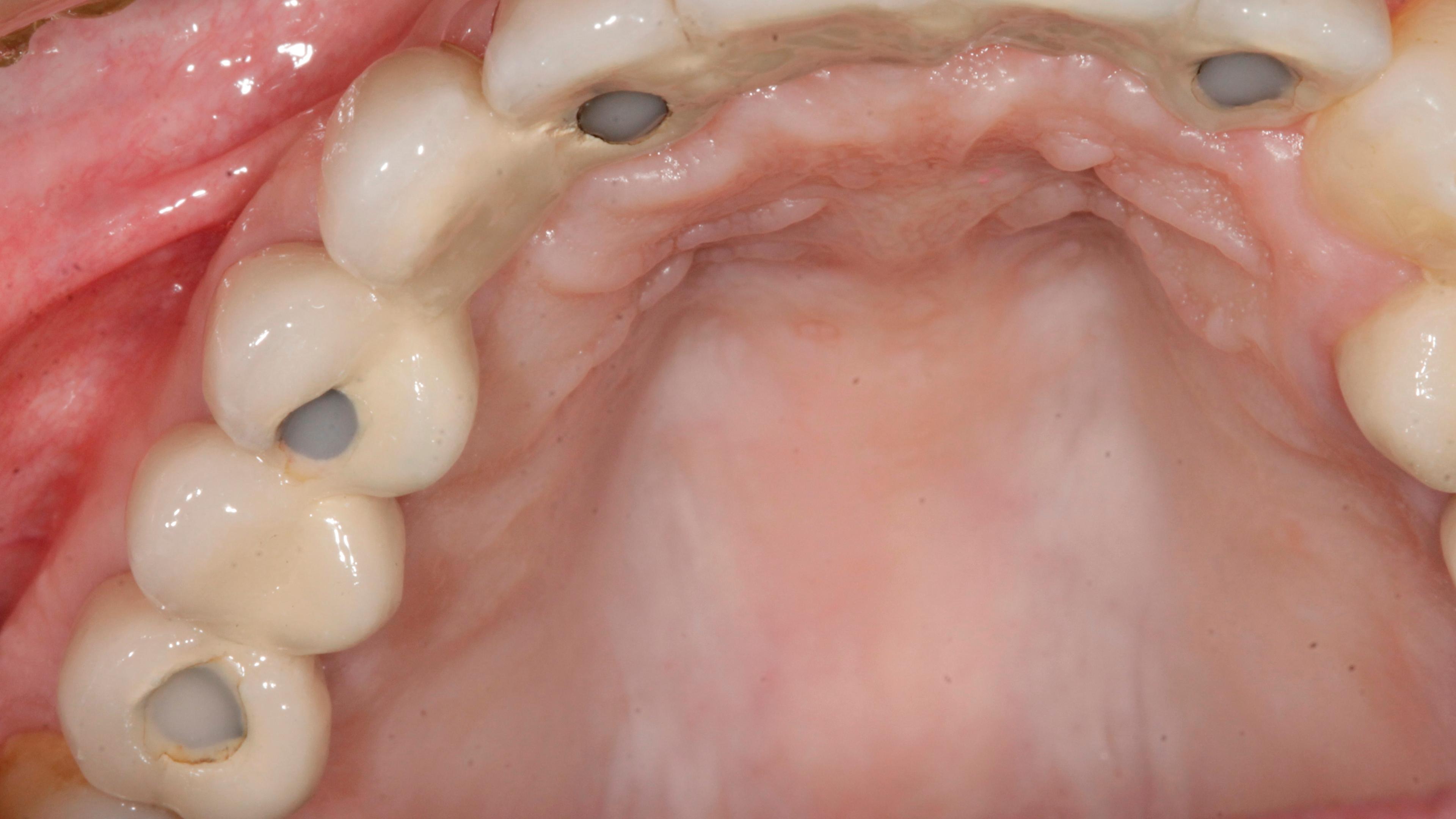 Πολλαπλες νωδοτητες Μετά την θεραπεία - Έλλειψη δοντιών άνω γνάθου