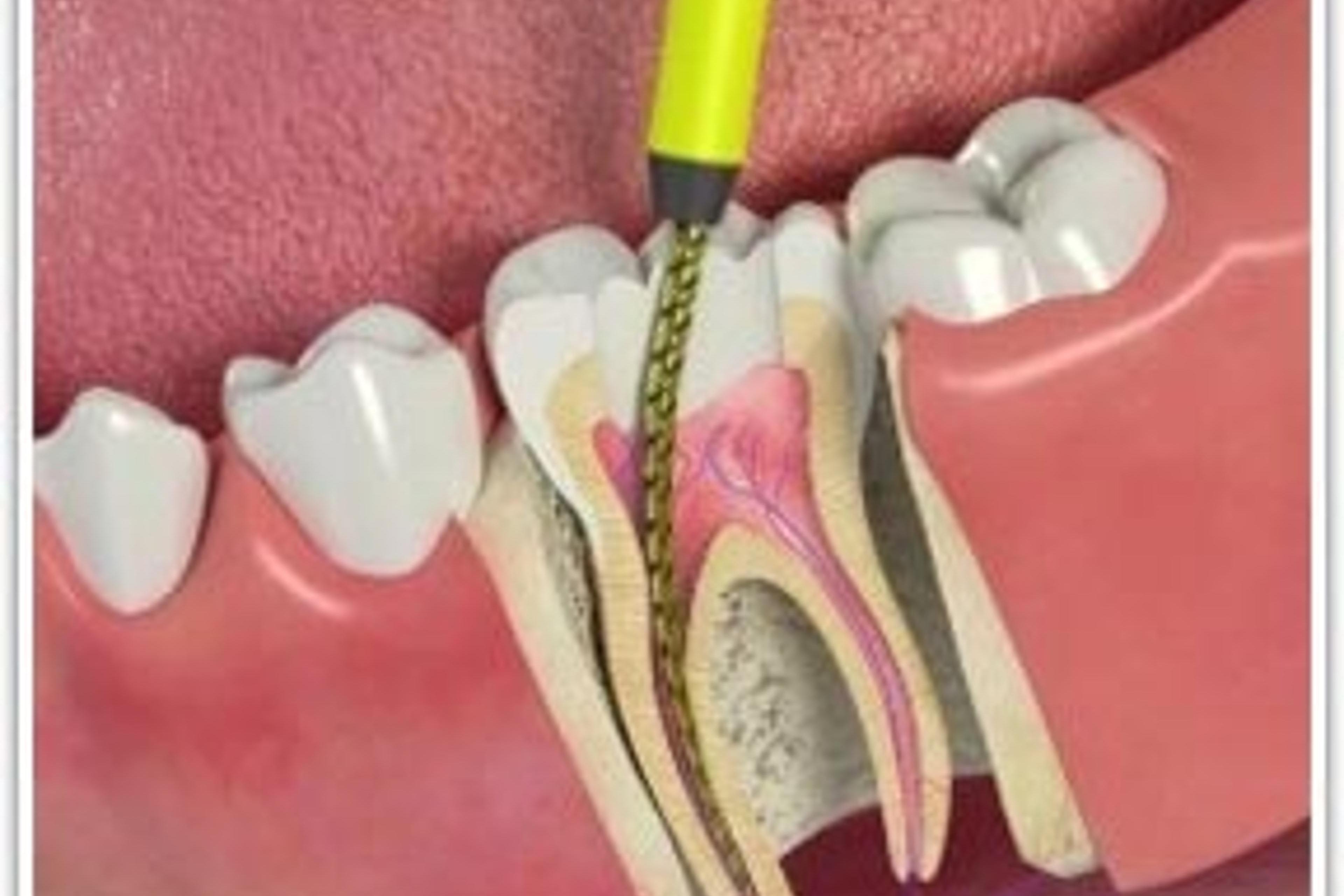 Preparation of root canals